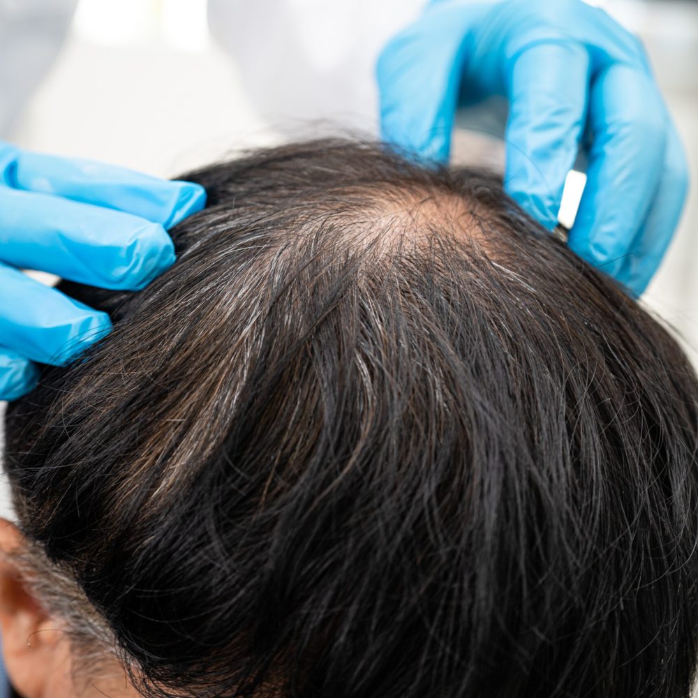 Doctor checkup and treatment Asian man baldness hair problem patient.